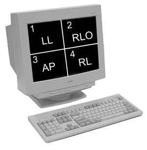 1 - LL, 2 - RLO, 3 - AP, 4 - RL